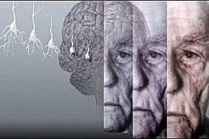 Симптомы деменции