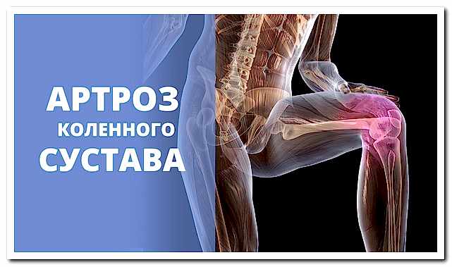 артроз коленного сустава