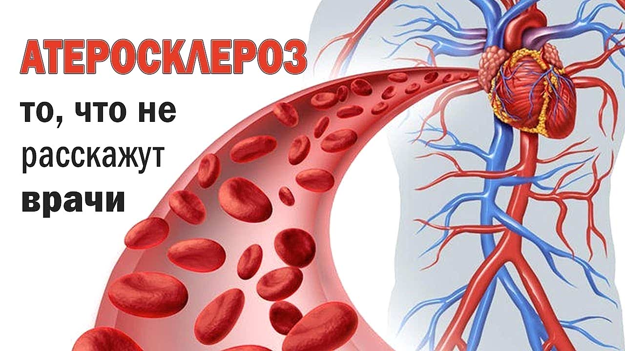 атеросклероз
