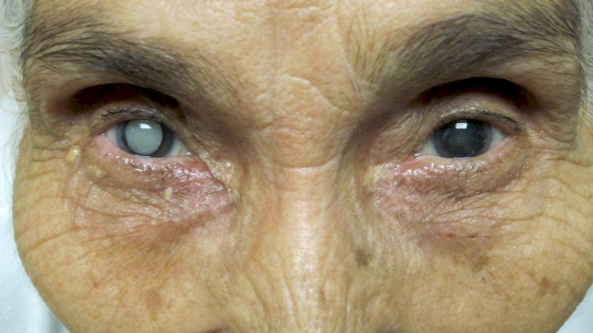 катаракта глаза