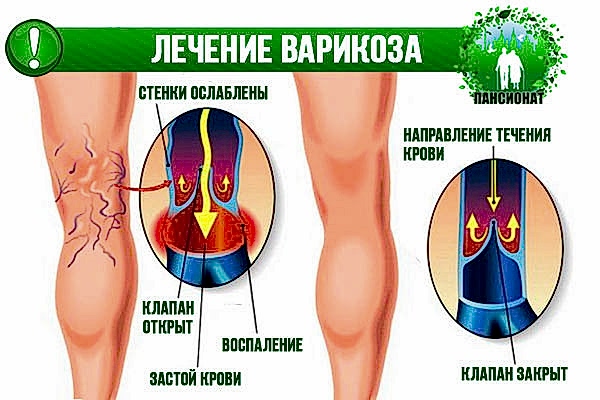 лечение варикоза на ногах