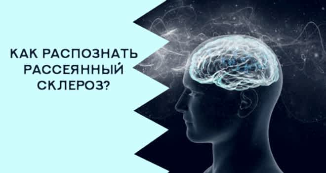 рассеянный склероз