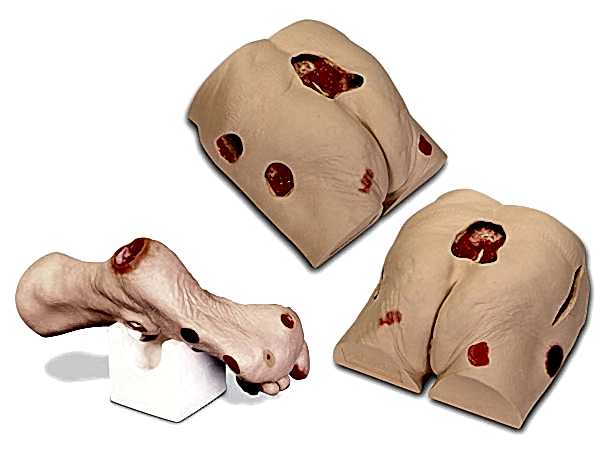 реабилитация при пролежнях