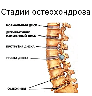 стадии остеохондроз
