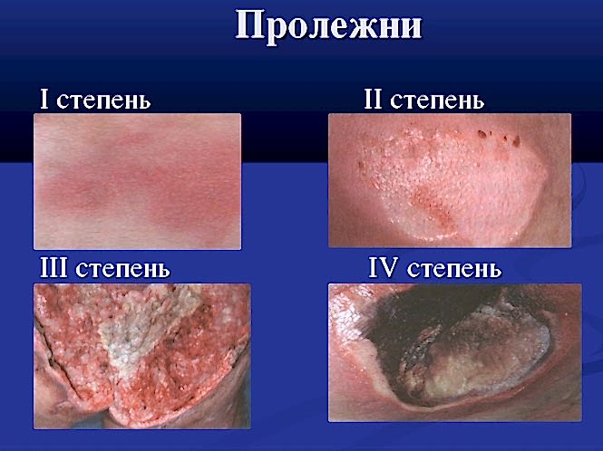 стадии пролежней