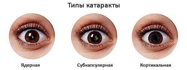 виды катаракты